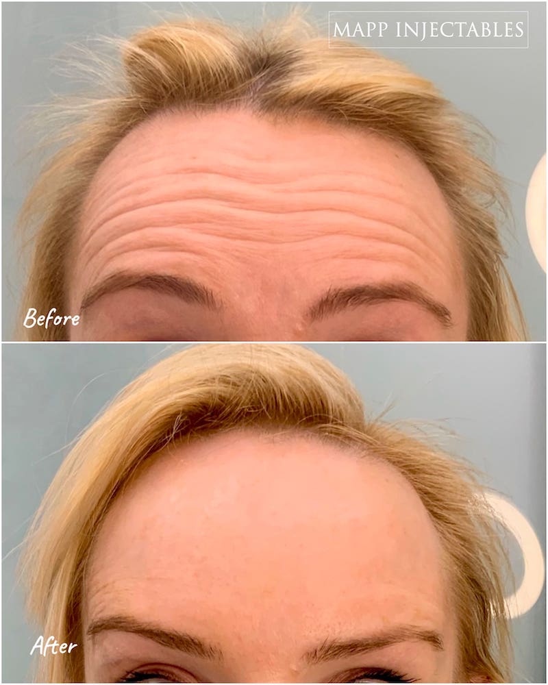 AntiWrinkle Before and After Mapp Injectables